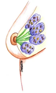 Boala fibrochistica san