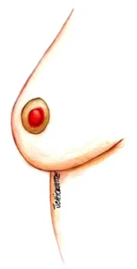 Galactoforita san