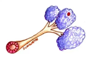 Neoplazia lobulară