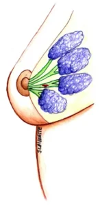 Papilom intraductal san ICP